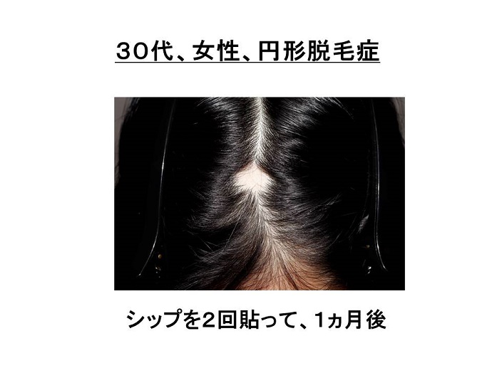 円形脱毛症　病院